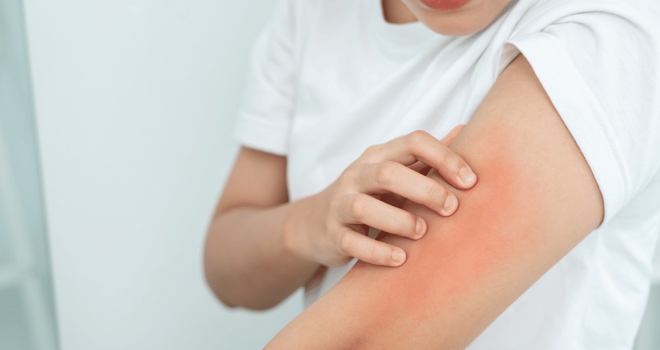 Skin Allergy Treatment in Solapur