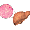 Fatty Liver Symptoms in Solapur