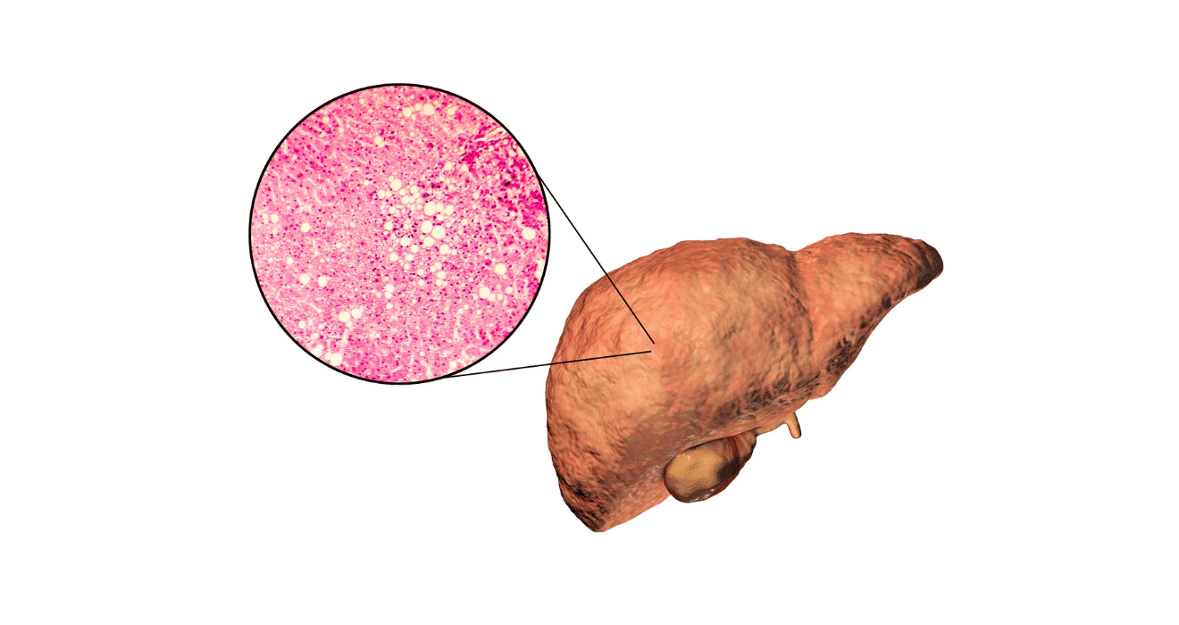 Fatty Liver Symptoms in Solapur