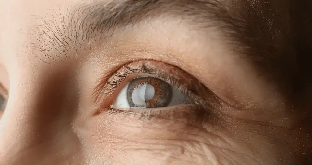 Cataract symptoms in Solapur causing blurred vision