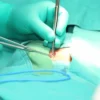 Hernia treatment in Solapur for abdominal bulge and pain