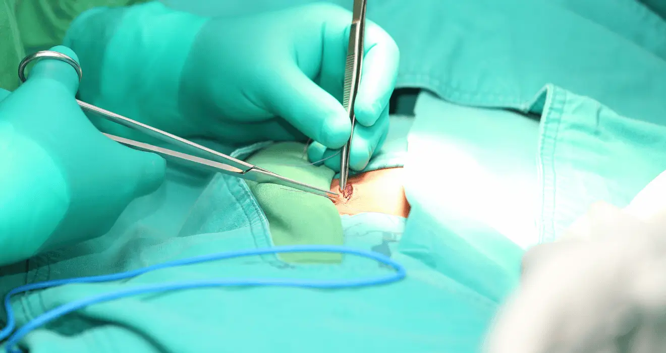 Hernia treatment in Solapur for abdominal bulge and pain